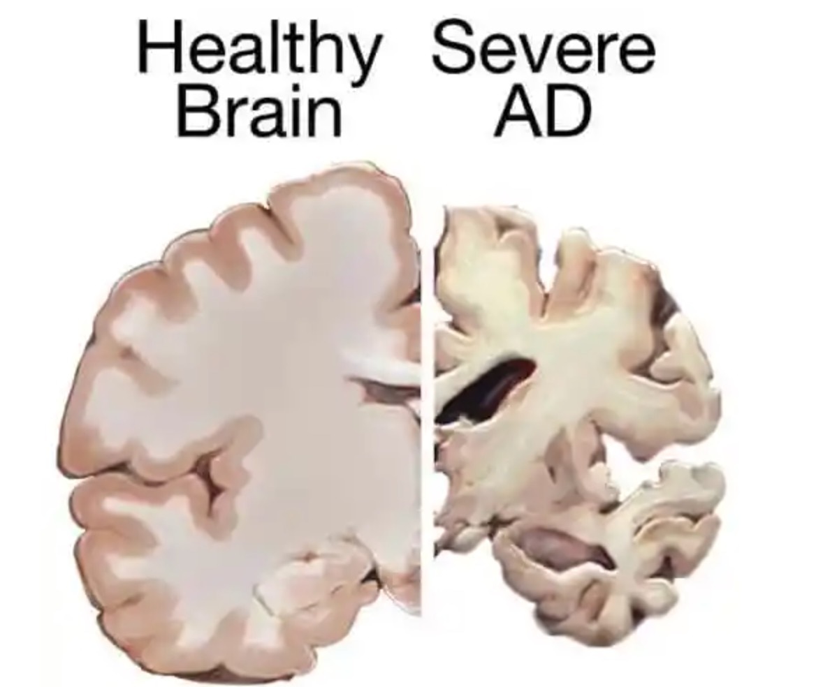 健康脑截面（左），患阿兹海默症后会导致脑萎缩（右）