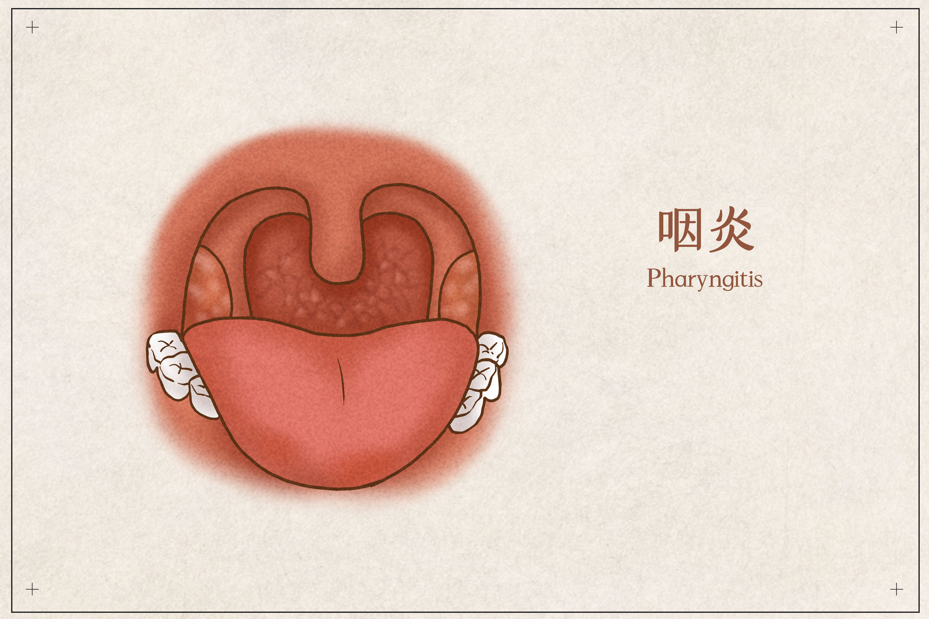 慢性咽炎照片图片