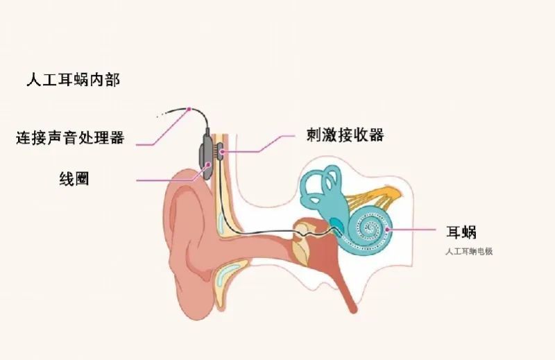 重获新“声”︱安徽中科庚玖耳鼻咽喉头颈外科常态化开展人工耳蜗植入术凤凰网安徽_凤凰网