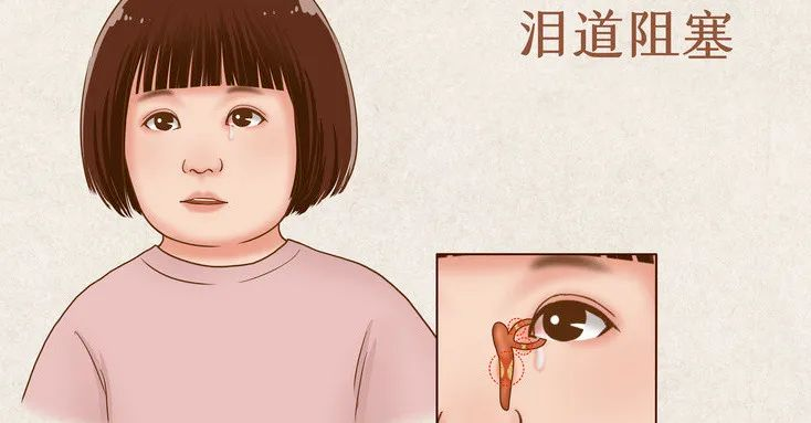 “迎风流泪”是怎么一回事?凤凰网陕西_凤凰网