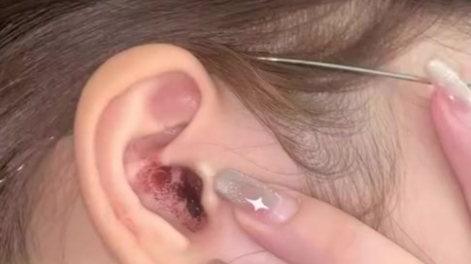 19岁女生戴耳机睡觉致耳朵流血流脓当事人每天戴耳机近10小时