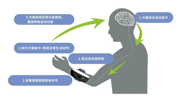 上肢怎么康复生物反馈疗法（EMG）如何运用到偏瘫患者的手功能康复？_https://www.jmylbn.com_新闻资讯_第7张