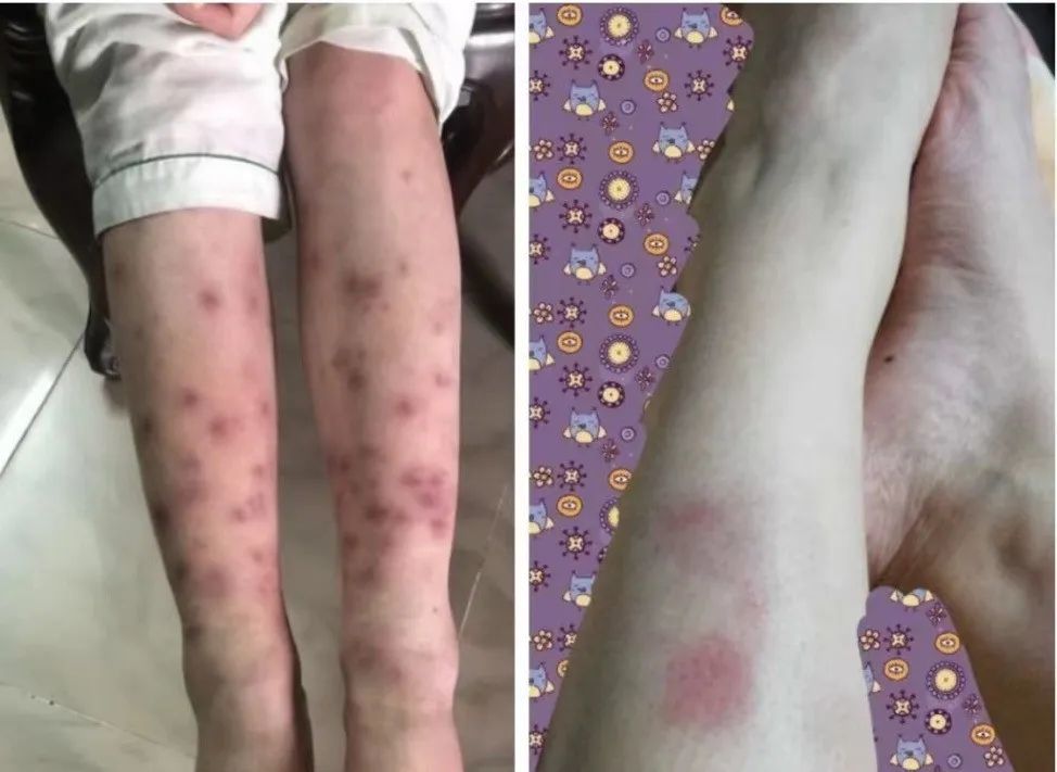 (三)中医如何治疗该病的形成主要是由于外感邪气,内有湿热,外邪与湿热