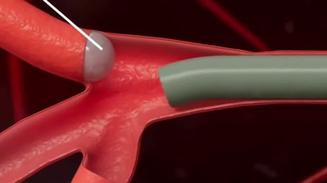 对于严重的前列腺增生，这两种介入治疗方法能有效避免后遗症