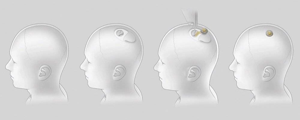 Neuralink脑机接口植入示意图 来自：视觉中国