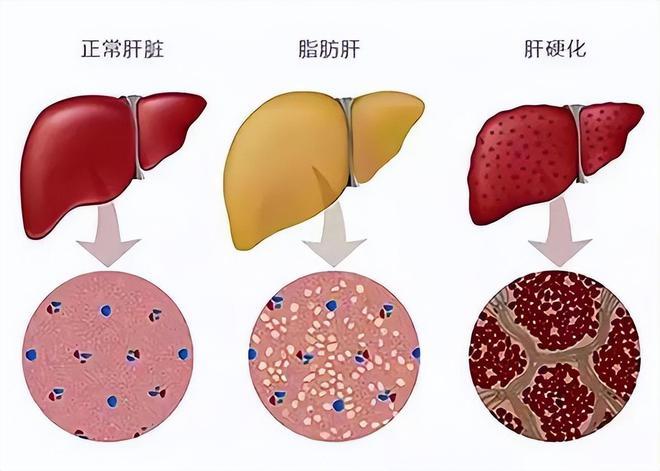 肝货来了，脂肪肝的6种信号！如何养肝护肝？护肝片真的有用吗？