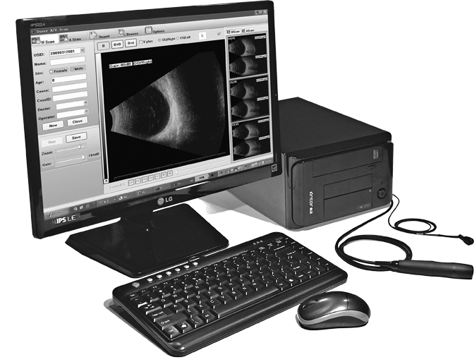 眼部b超检查结果示例功能:排查高度近视引起的眼底病变,视网膜脱离