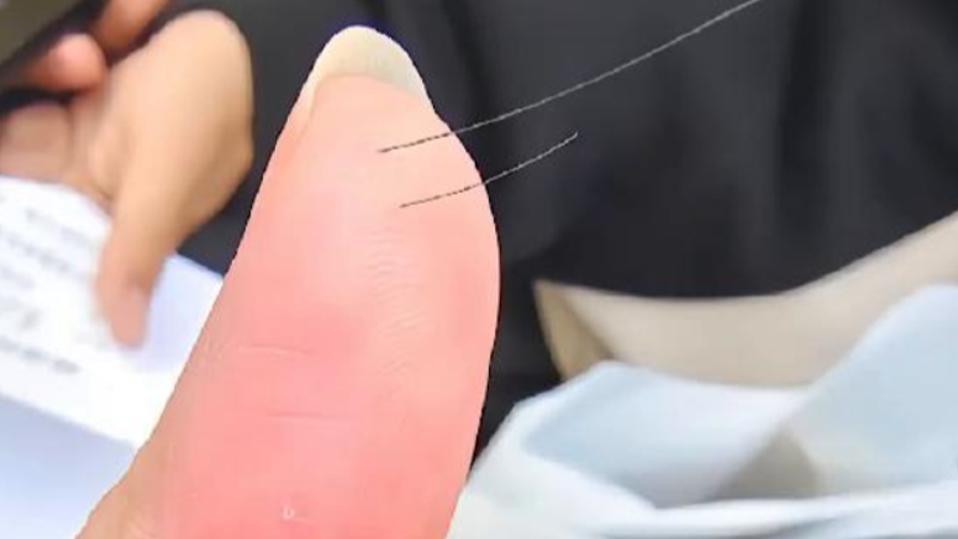 女子帮丈夫清理头屑，结果手指被头发扎入1厘米深，拔出来一瞬间手指流血了