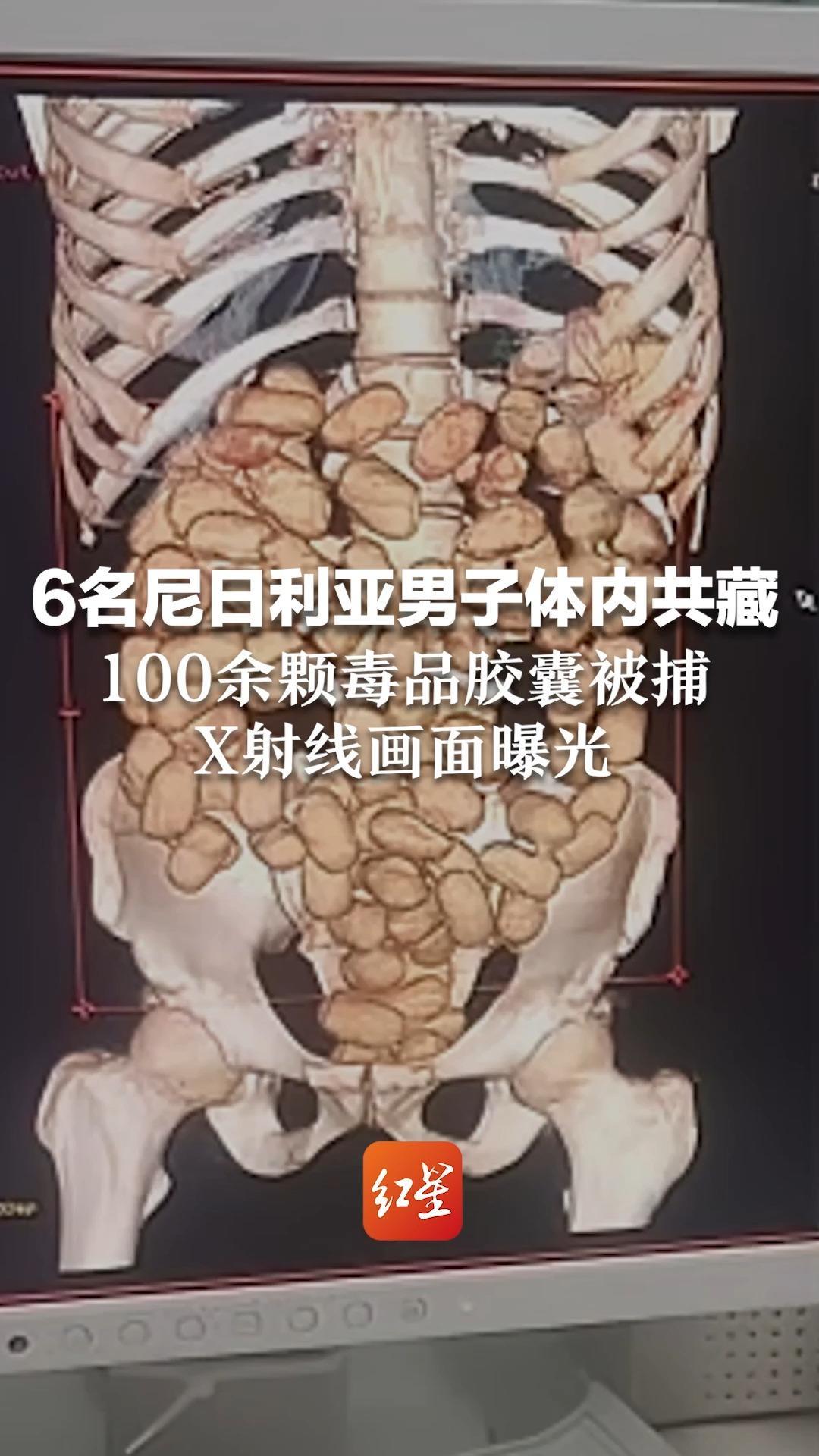 体内藏毒死亡图片