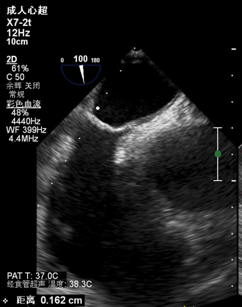 经食道心脏超声图片