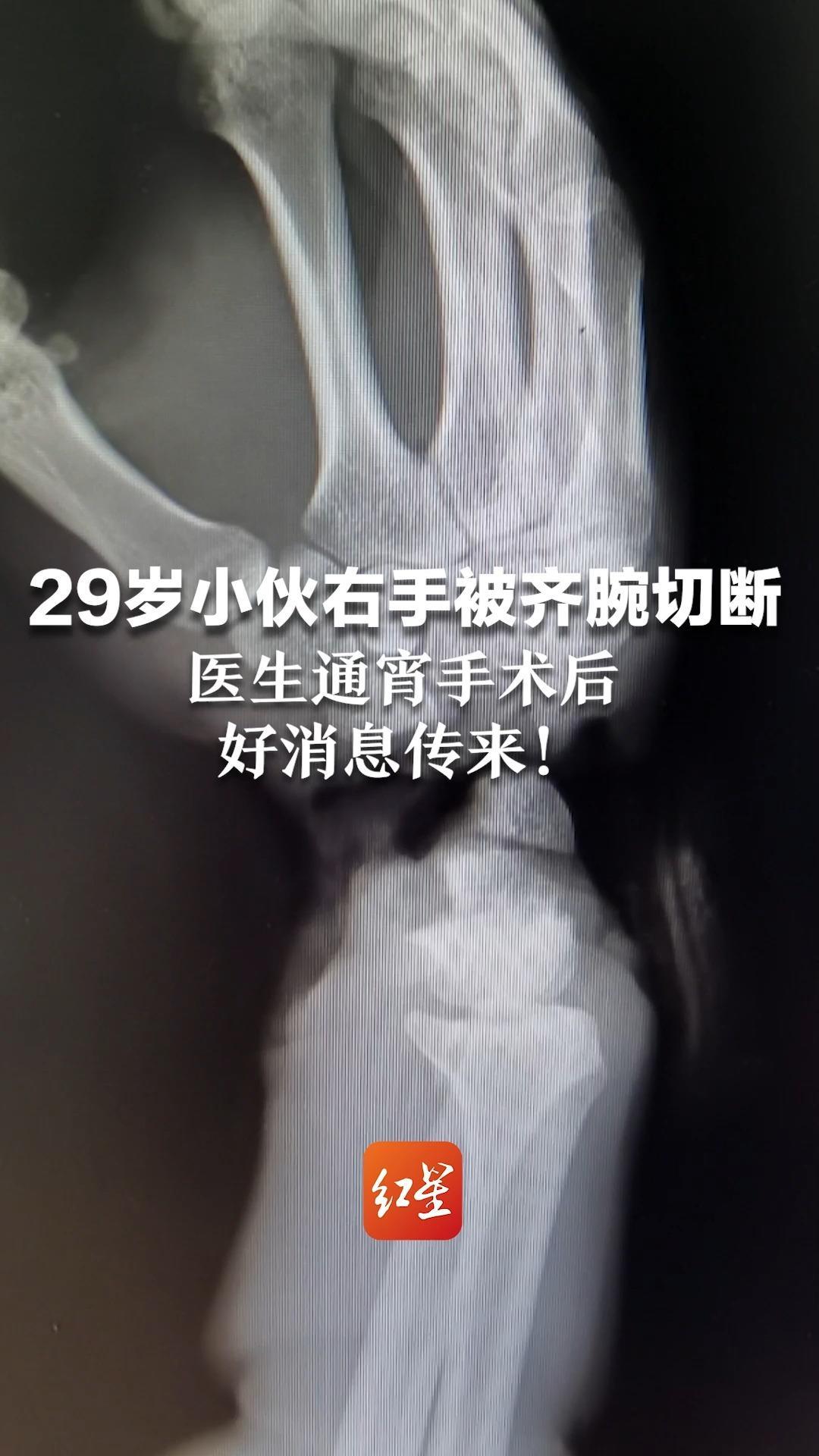 29岁小伙右手被齐腕切断，医生通宵手术后，好消息传来