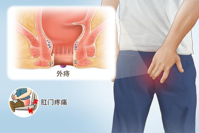 医生:肛门若常有4种不适,警惕癌症在靠近凤凰网北美_凤凰网