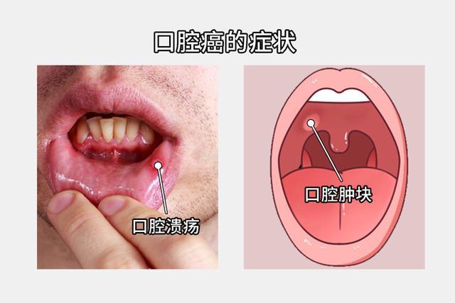 吞嚥疼痛,頸部摸到相對固定的腫大淋巴結等症狀也可能提示口腔癌的