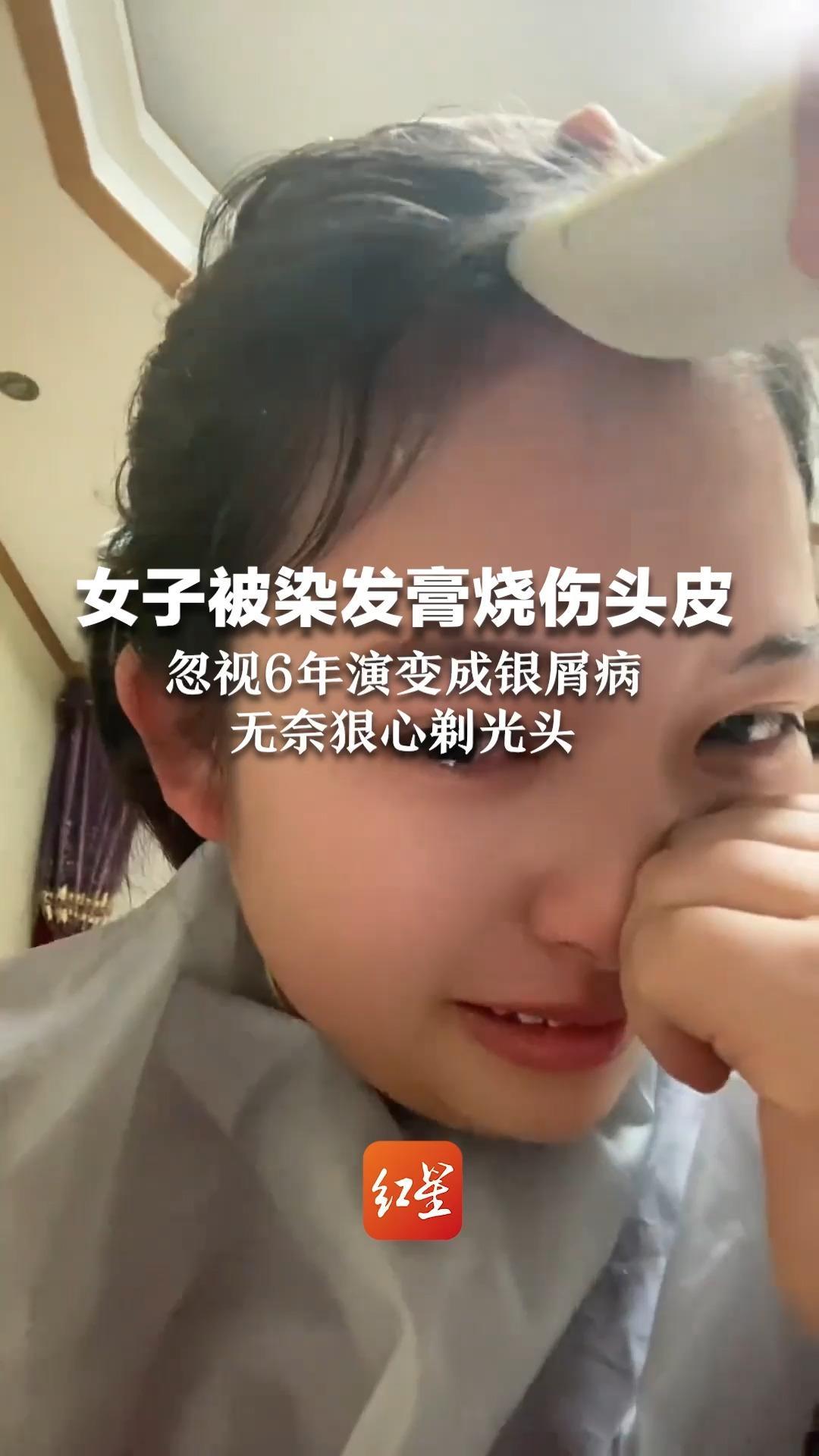 女子被染发膏烧伤头皮 忽视6年演变成银屑病 无奈狠心剃光头