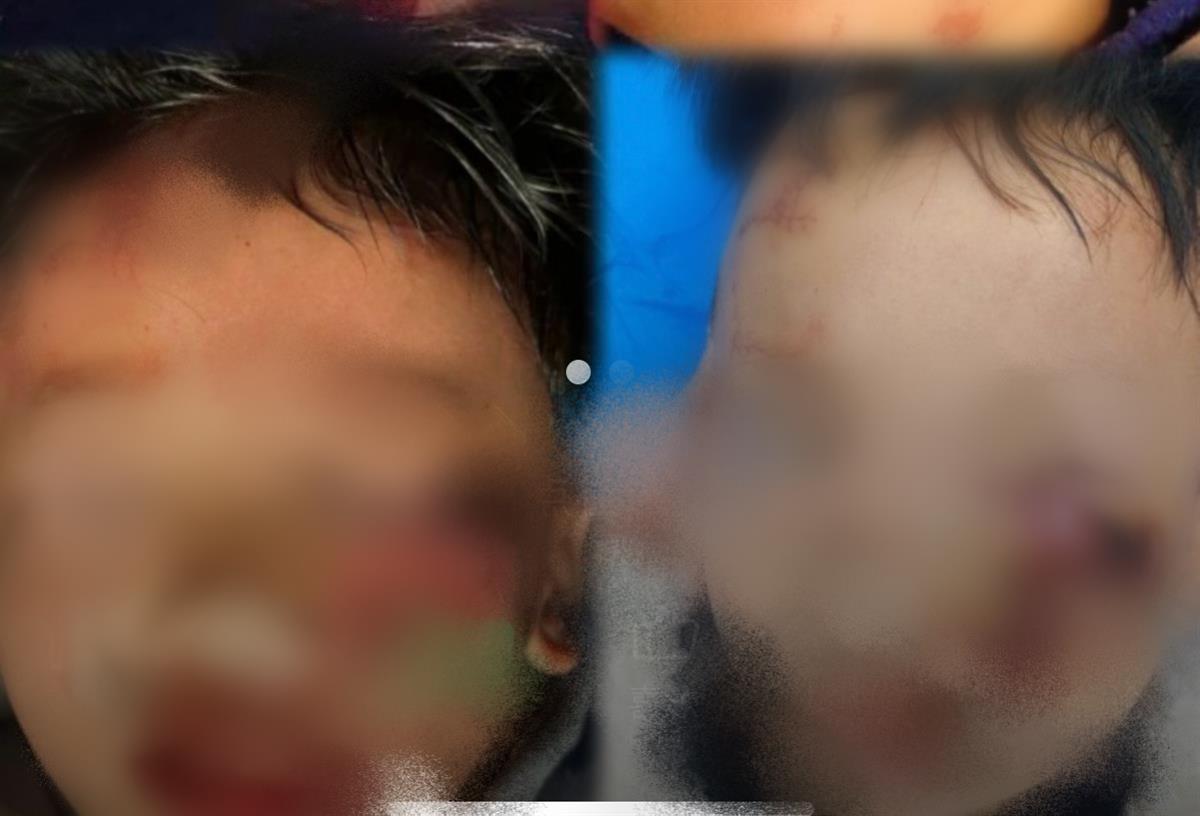 江西8岁男童被狗咬伤面部缝了90多针 警方:狗已处理,还在核实狗主人