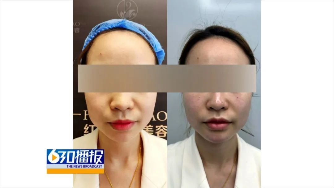 女子刷2万多在赣州红俏医疗美容做医美 做完后不敢大笑