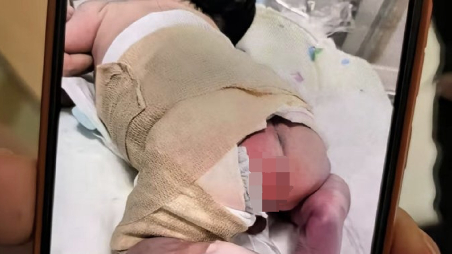 仅出生两天婴儿因护士疏忽被烫伤，8天后，终于传来好消息“孩子长新皮肤了”，涉事护士已停岗接受调查