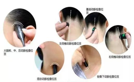 TCD怎么切换探头小探头 大作用——脑部的听诊器_https://www.jmylbn.com_新闻资讯_第3张