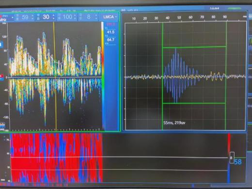 TCD怎么切换探头小探头 大作用——脑部的听诊器_https://www.jmylbn.com_新闻资讯_第8张