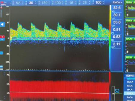 TCD怎么切换探头小探头 大作用——脑部的听诊器_https://www.jmylbn.com_新闻资讯_第5张