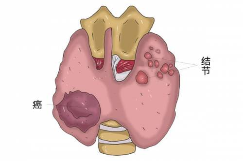 体检发现甲状腺结节怎么办