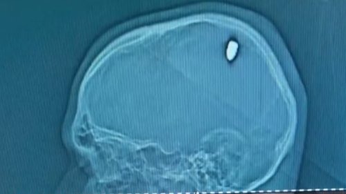 巴西男子头部中弹4天后才发现：当时以为被石头打中