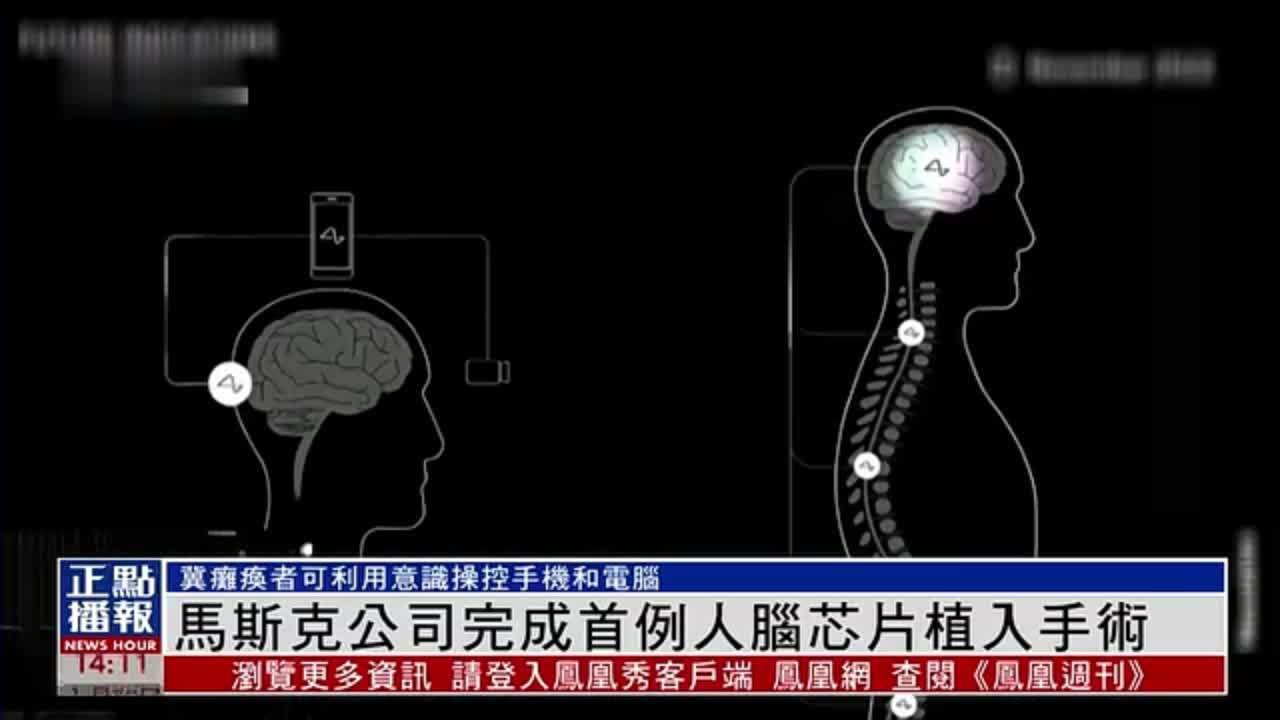 大脑芯片植入技术图片