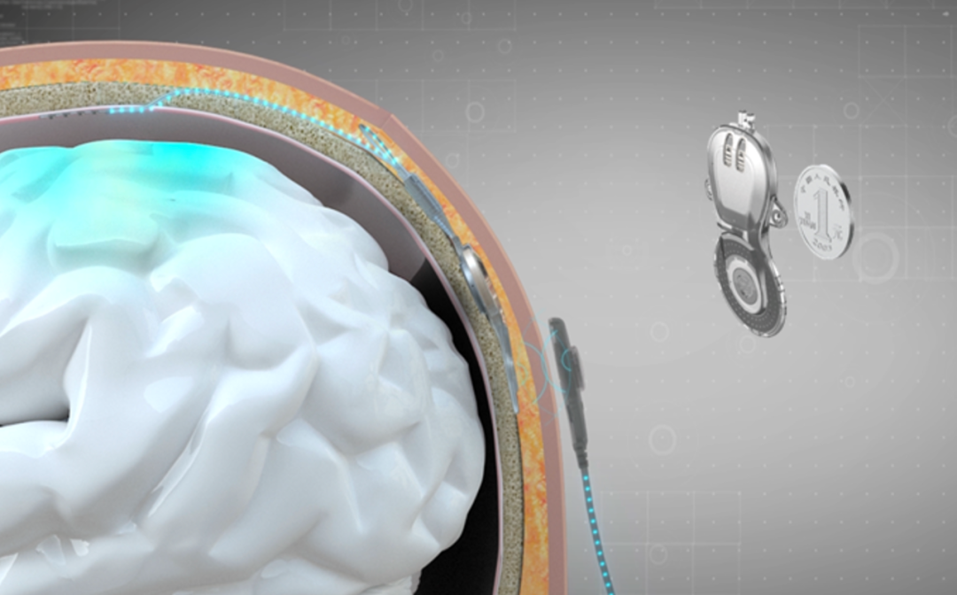 无线微创植入脑机接口NEO系统及 其体内机。图片来源：清华大学，洪波 制作