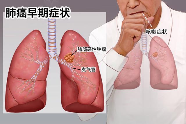 肺癌咳血图片 晚期图片