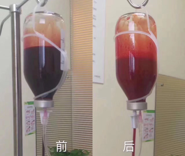 三氧疗法怎么代理三氧自体血回输疗法见奇效 ｜ 西安市红会医院介入诊疗中心成功开展首例自体血回输治疗_https://www.jmylbn.com_新闻资讯_第5张