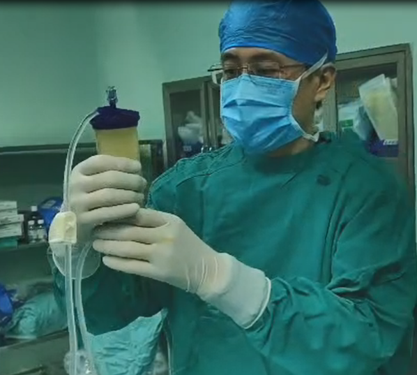 提取自体脂肪微片段