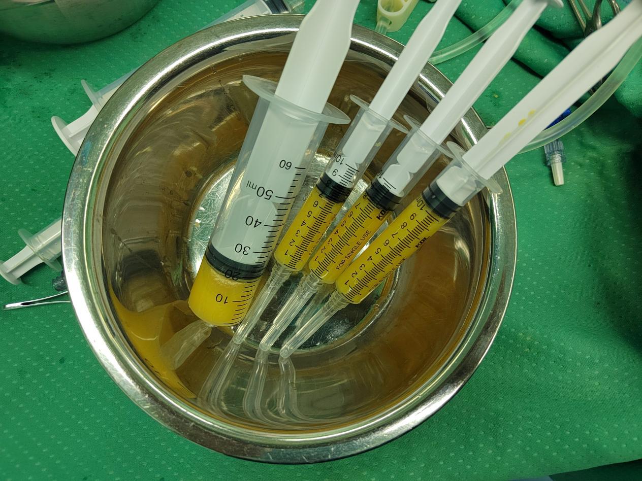 提取备用的自体脂肪微片段液