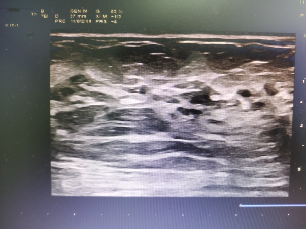 十年顽疾一针除超声科完成双侧乳腺乳管扩张脓肿射频消融术