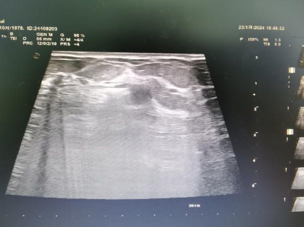 十年顽疾一针除超声科完成双侧乳腺乳管扩张脓肿射频消融术