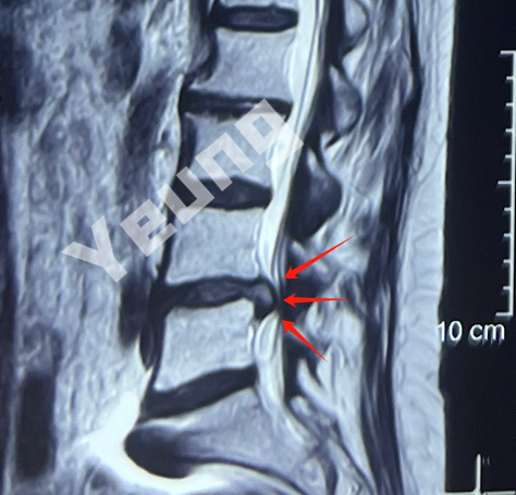 脊柱裂核磁图片