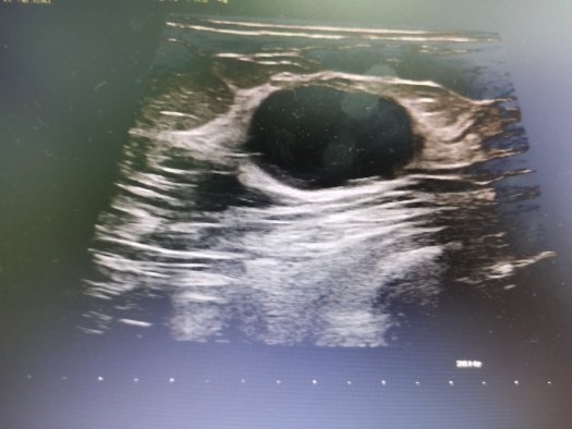 十年顽疾一"针"除——超声科完成双侧乳腺乳管扩张脓肿射频消融术