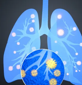 别被陈桂林吐黑水带偏了肺结节肺囊肿会成肺癌吗