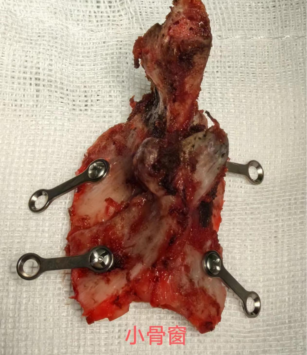 九江市中医医院成功完成一例高节段颈髓肿瘤切除术