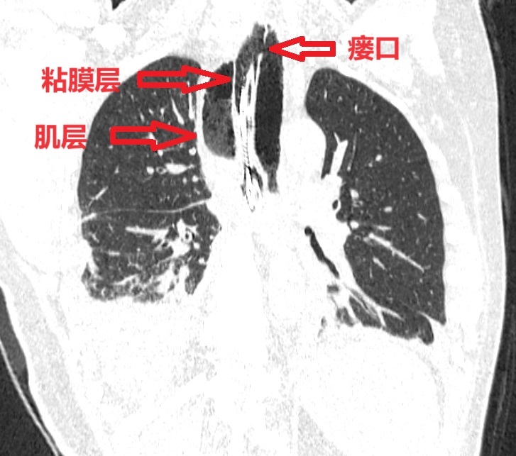 食管气管瘘影像学表现图片