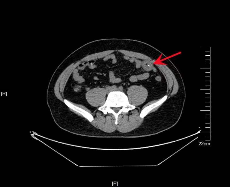 腹痛难忍竟是鱼刺作祟小肠镜巧取异物成功排险