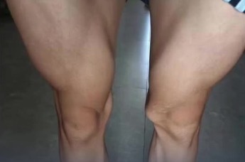 错切17岁体育生右膝主刀医生被撤职 卫健委：会请第三方医院专家评估 家长：未接受赔偿 不想协商