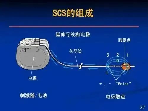 “ 介”显神通 解锁疼痛密码：揭秘植入式脊髓电刺激技术