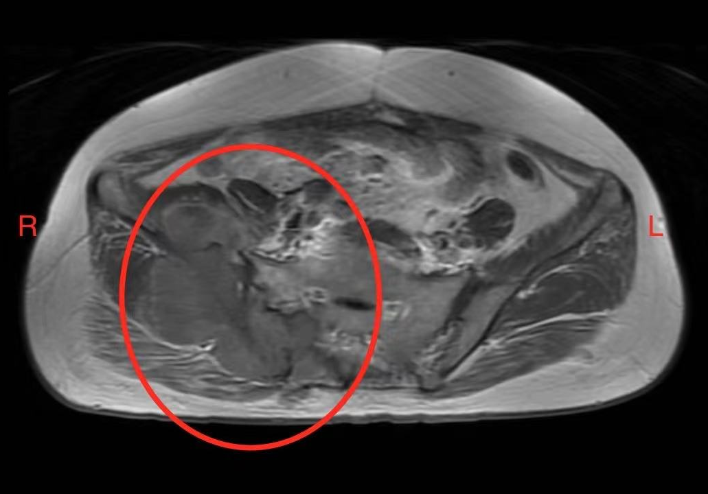 图2：右侧臀区包块核磁影像（仰卧位）