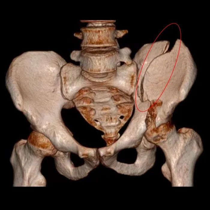▲ 患者骨盆粉碎性骨折（骨盆CT三维重建图）