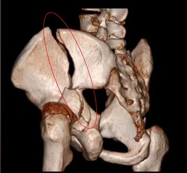 ▲ 患者左侧髂骨、髋臼粉碎性骨折伴髋关节半脱位（骨盆CT三维重建图）
