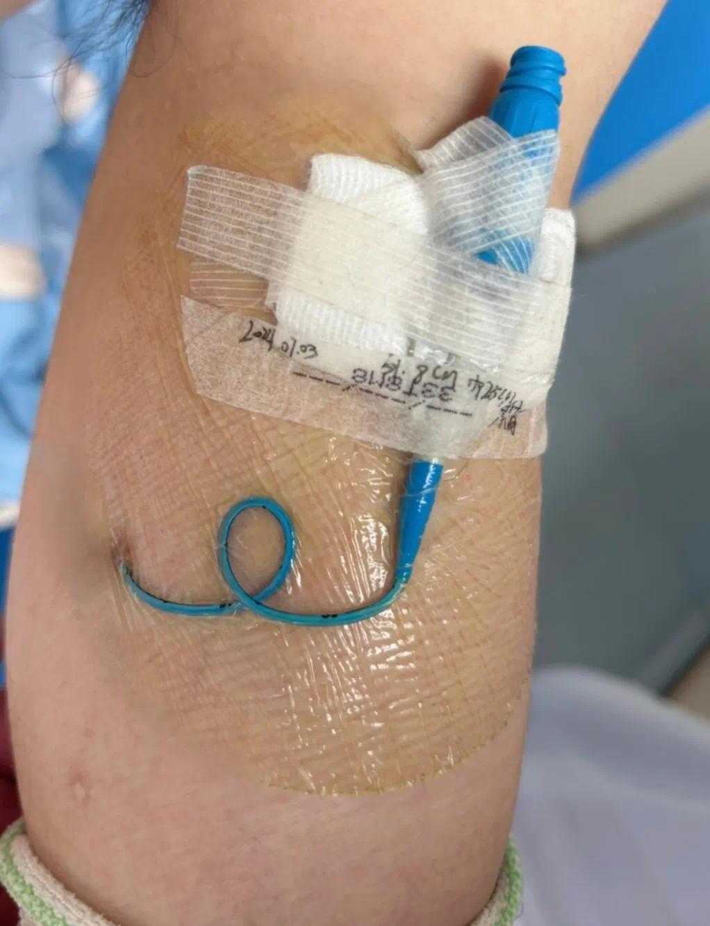 picc导管是什么材质【品质世博】PICC一“管”到底——肿瘤患者的最佳伴侣_https://www.jmylbn.com_新闻资讯_第2张