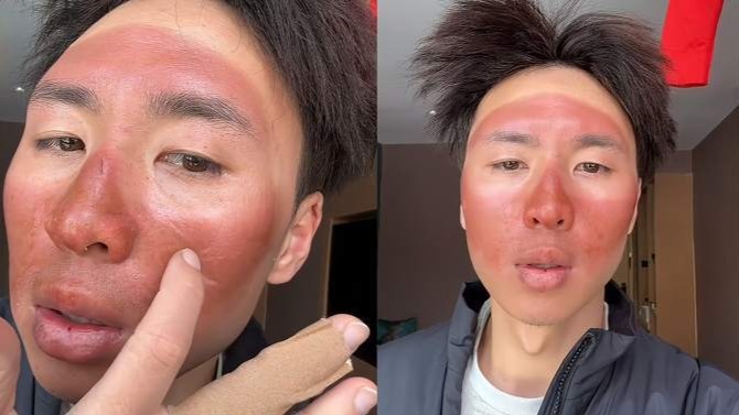 男子爬3天雪山没做防晒,脸被晒伤成"面膜":大面积流脓,脱皮_凤凰网