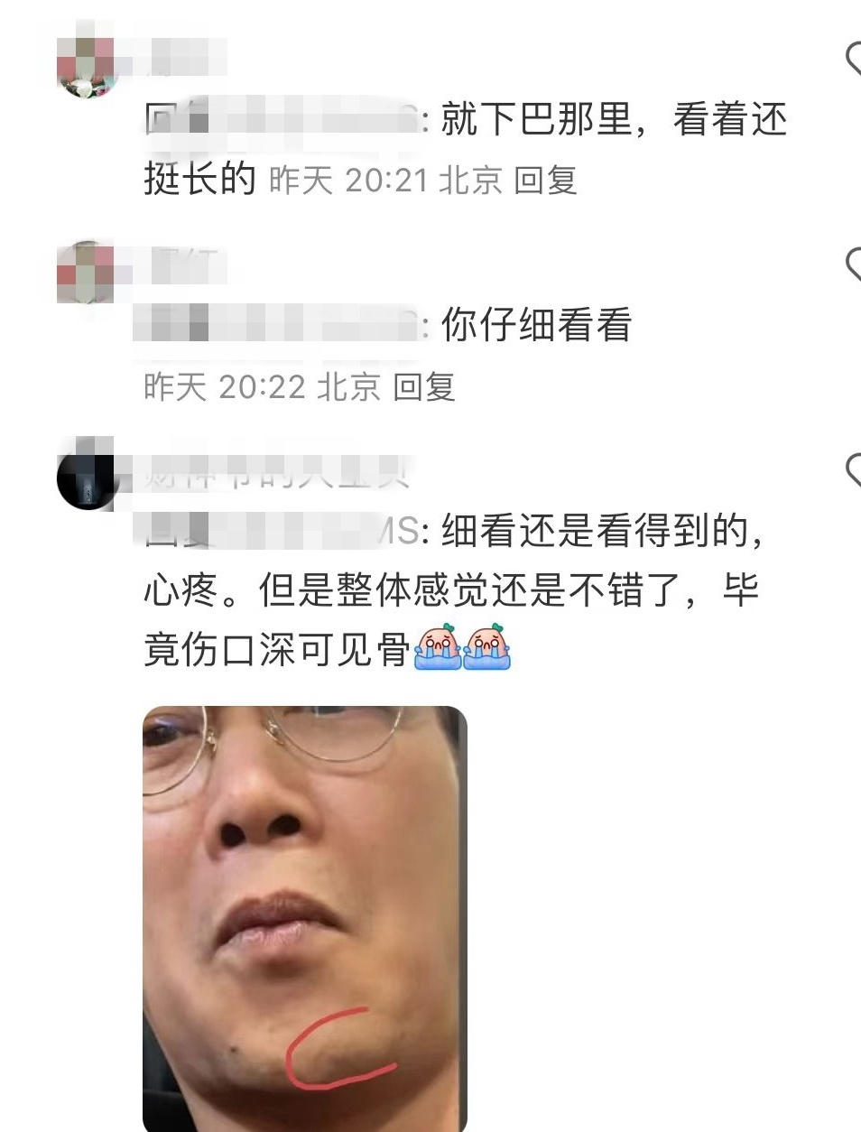 陈奕迅受伤一个月首露面，深可见骨的下巴伤口变成长疤痕，恢复情况良好