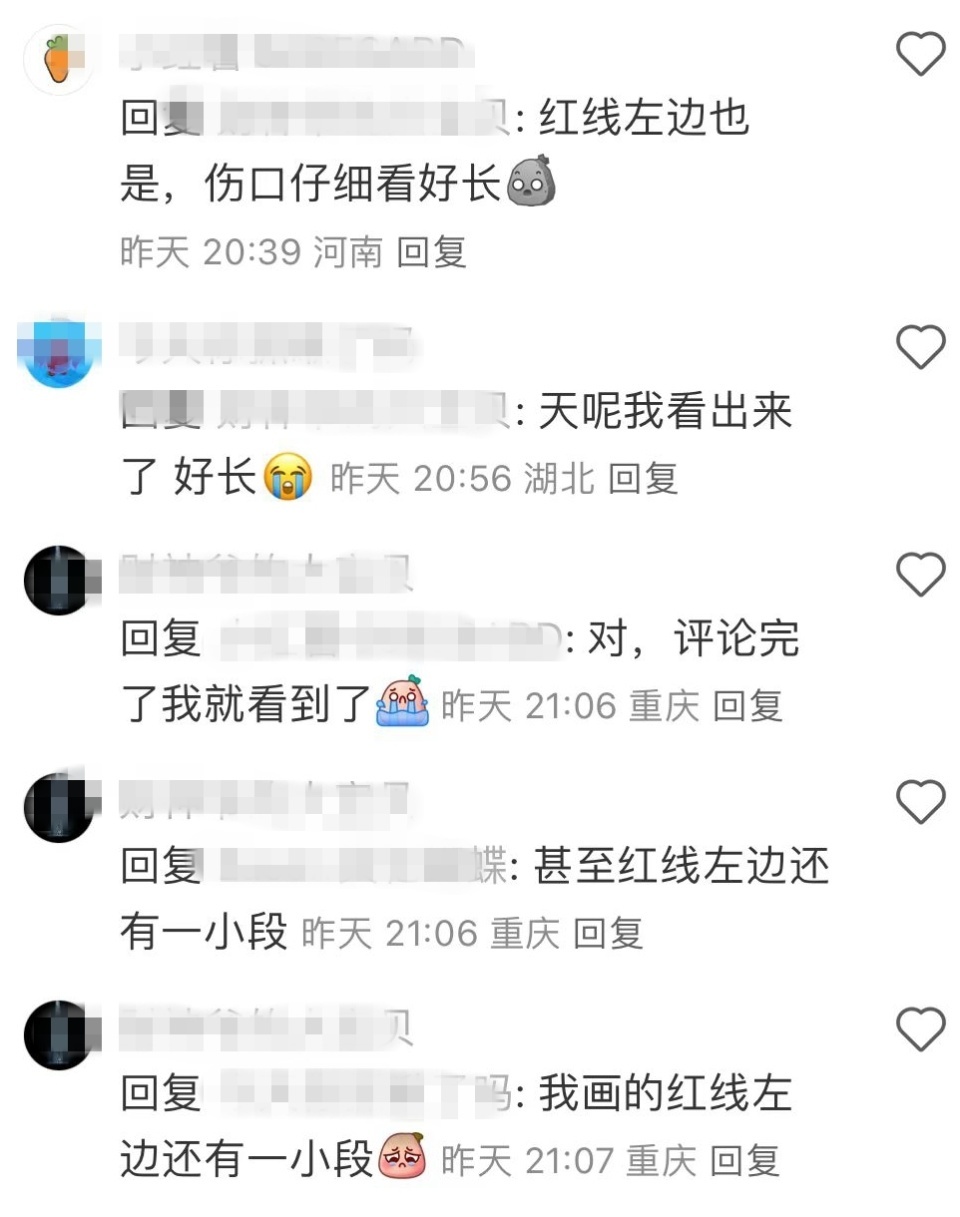 陈奕迅受伤一个月首露面，深可见骨的下巴伤口变成长疤痕，恢复情况良好