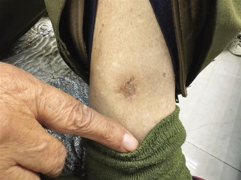蒋茂林被子弹打穿的腿部